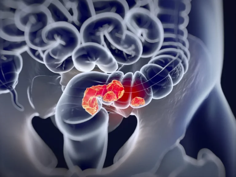 Colorectal cancer screening