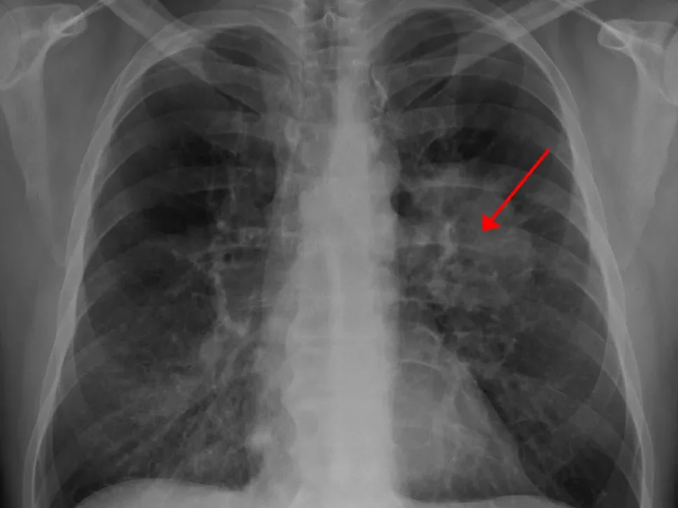 lung xray