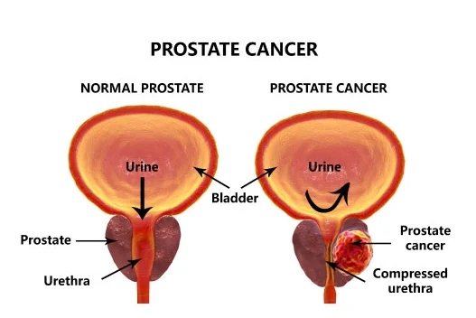 prostate